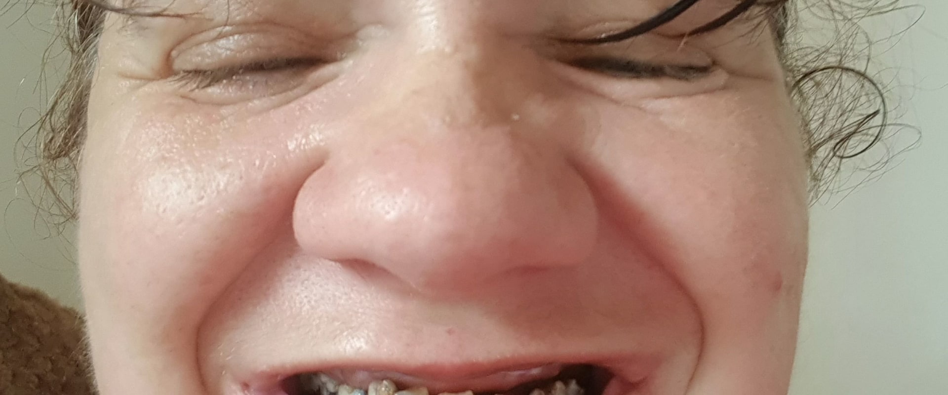 The Consequences of Avoiding the Dentist for 10 Years