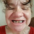 The Consequences of Avoiding the Dentist for 10 Years