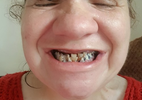 The Consequences of Avoiding the Dentist for 10 Years